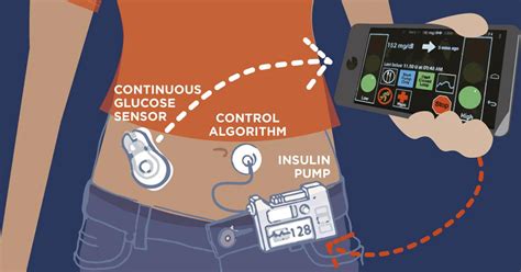 centrifugal pump in closed loop|fully closed loop insulin pump.